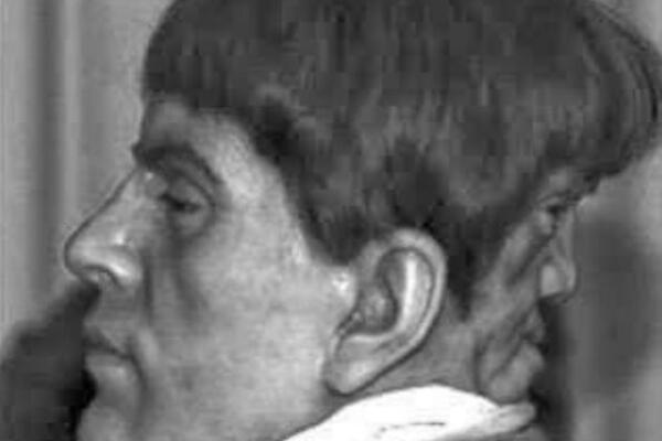 Na potiljku nosio lice "ĐAVOLJEG BLIZANCA" koji ga je terao na morbidne stvari! Šaputao mu grozote, SVE DOK NIJE...