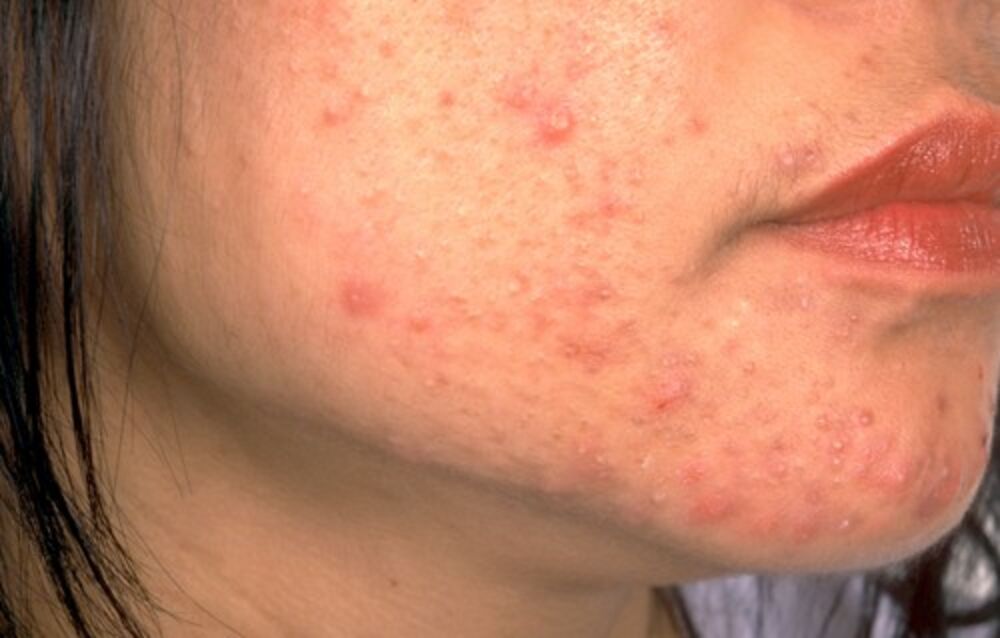 Akne, Lice, Tinejdžeri, Koža, Bubuljice