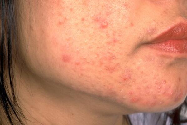 OPREZ! RODITELJI, OBRATITE PAŽNJU NA OVO! Ove navike mogu spasiti kožu vaše dece od akni, VAŽNO JE DA POČNETE ODMAH