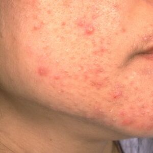 OPREZ! RODITELJI, OBRATITE PAŽNJU NA OVO! Ove navike mogu spasiti kožu vaše dece od akni, VAŽNO JE DA POČNETE ODMAH