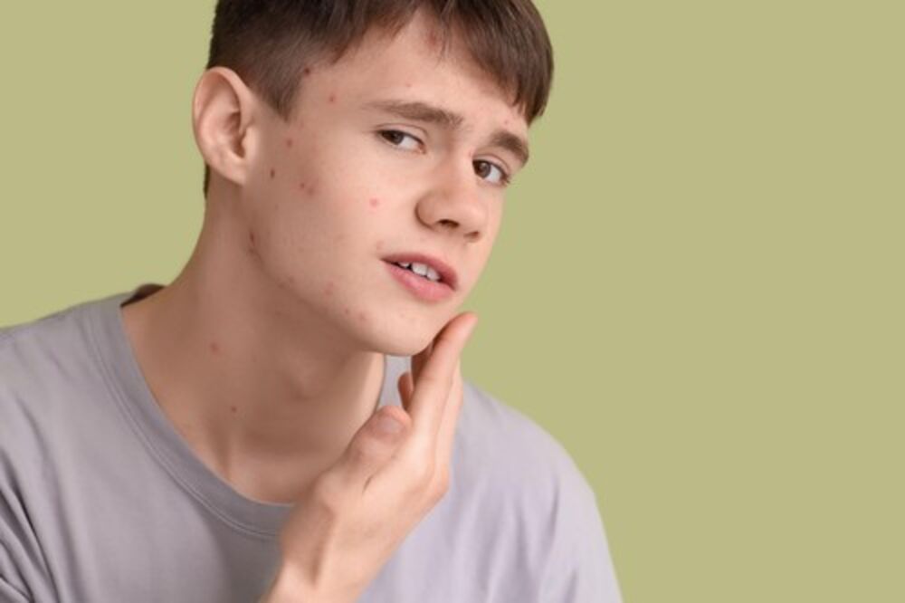 Akne, Lice, Tinejdžeri, Koža, Bubuljice