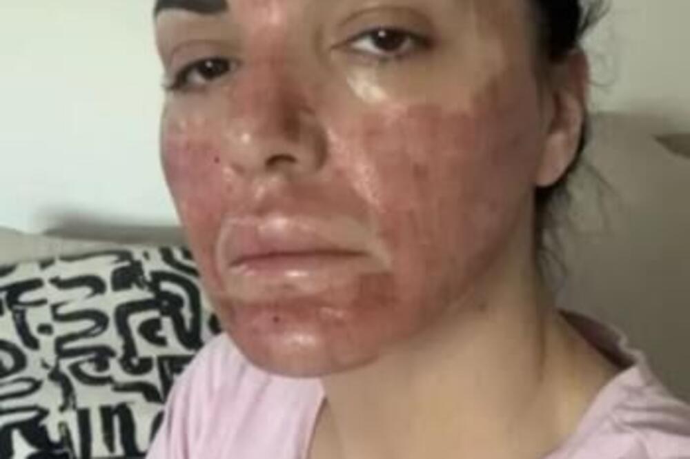 KO JOŠ OVO SEBI RADI? Zoki lice NATOPLJENO KRVLJU, ne liči na sebe! Slika je UZNEMIRUJUĆA