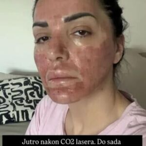 KO JOŠ OVO SEBI RADI? Zoki lice NATOPLJENO KRVLJU, ne liči na sebe! Slika je UZNEMIRUJUĆA