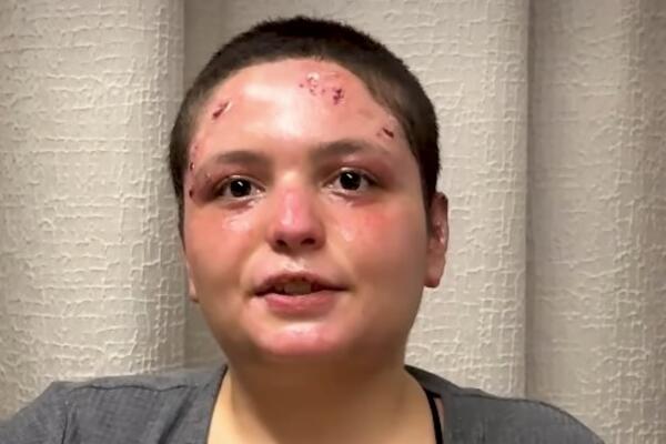 Preživela žrtva požara u Švajcarskoj opisala detalje horora: "Videla sam šta je držala u rukama" (VIDEO)