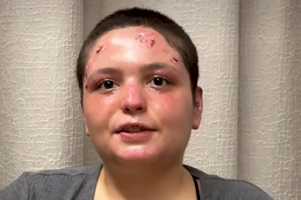 Preživela žrtva požara u Švajcarskoj opisala detalje horora: "Videla sam šta je držala u rukama" (VIDEO)