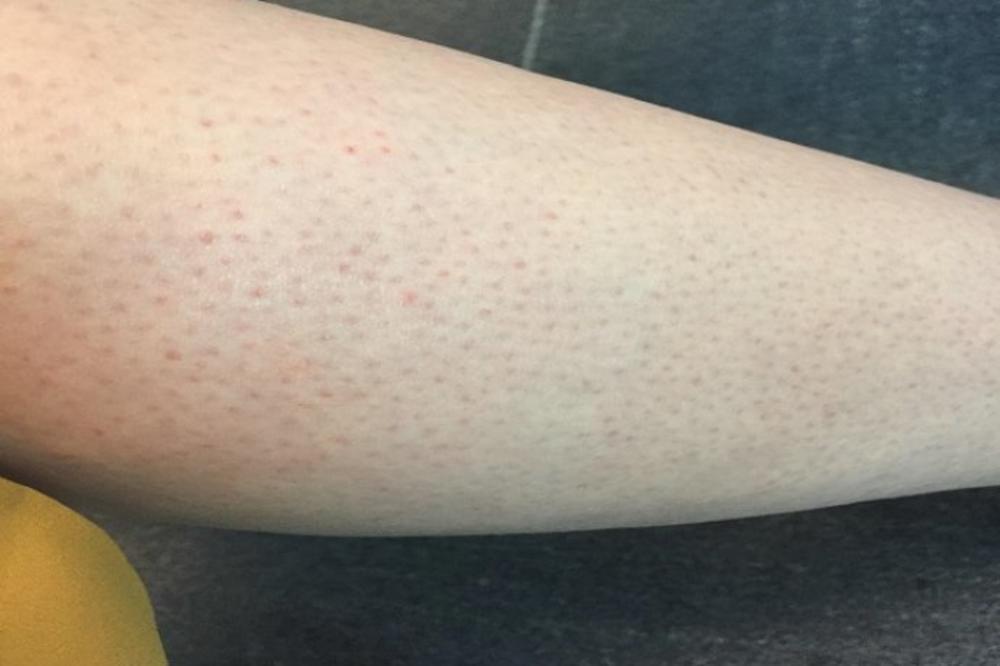 IMATE LI CRVENE TAČKICE NA NOGAMA KAO JAGODE? ŽENE, OBRATITE PAŽNJU, kada čujete 4. razlog, sve će vam biti jasno