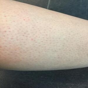 IMATE LI CRVENE TAČKICE NA NOGAMA KAO JAGODE? ŽENE, OBRATITE PAŽNJU, kada čujete 4. razlog, sve će vam biti jasno