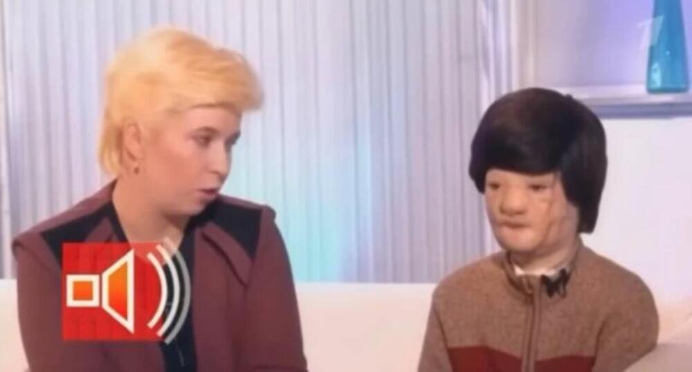 IGORA JE MAJKA OSTAVILA SA STAFORDOM, KAD GA JE PAS BRUTALNO NAPAO: Pola lica mu je unakaženo, jedva preživeo napad