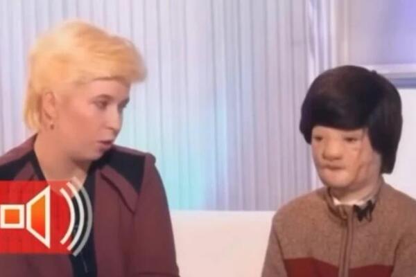 IGORA JE MAJKA OSTAVILA SA STAFORDOM, KAD GA JE PAS BRUTALNO NAPAO: Pola lica mu je unakaženo, jedva preživeo napad