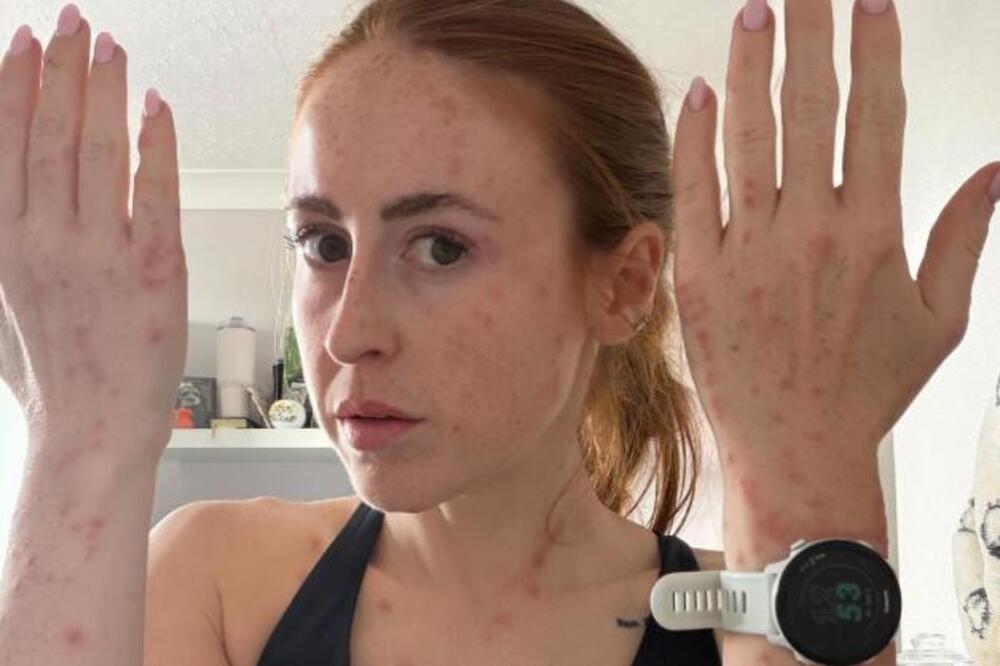 Hanu izujedale STENICE u poznatom hotelu, milile joj po JASTUKU! Kad vidite kako izgleda, SLOŠIĆE VAM SE (FOTO)
