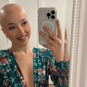 "GLEDAJ, ĆELAVA, UBIĆE JE RAK!" Emilia iz Pančeva je sa 20 godina dobila STRAŠNU DIJAGNOZU, danas je jača nego ikad