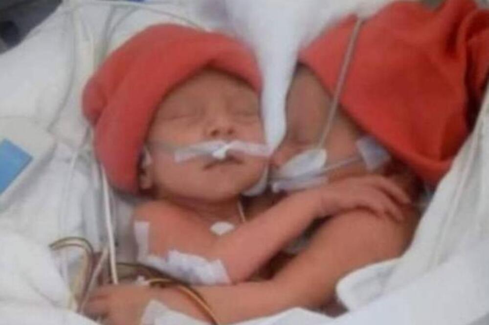 "NISAM SHVATALA ŠTA LEKAR..." Valentina i Kristina rođene kao SIJAMSKE BLIZNAKINJE, razdvajali ih 15 sati, a sad...