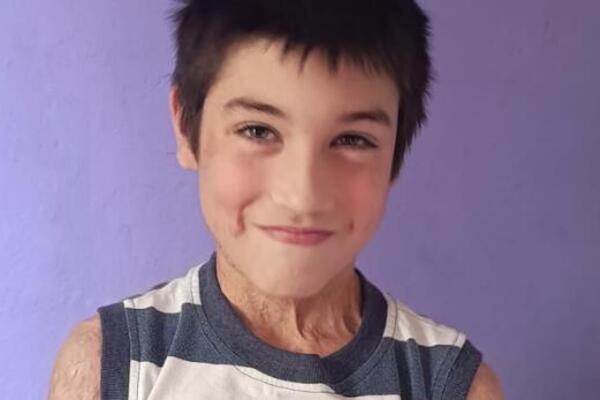 Nikolu je majka polila kiselinom pa je sa njim skočila sa trećeg sprata: Ostale su brojne posledice, pomozimo!