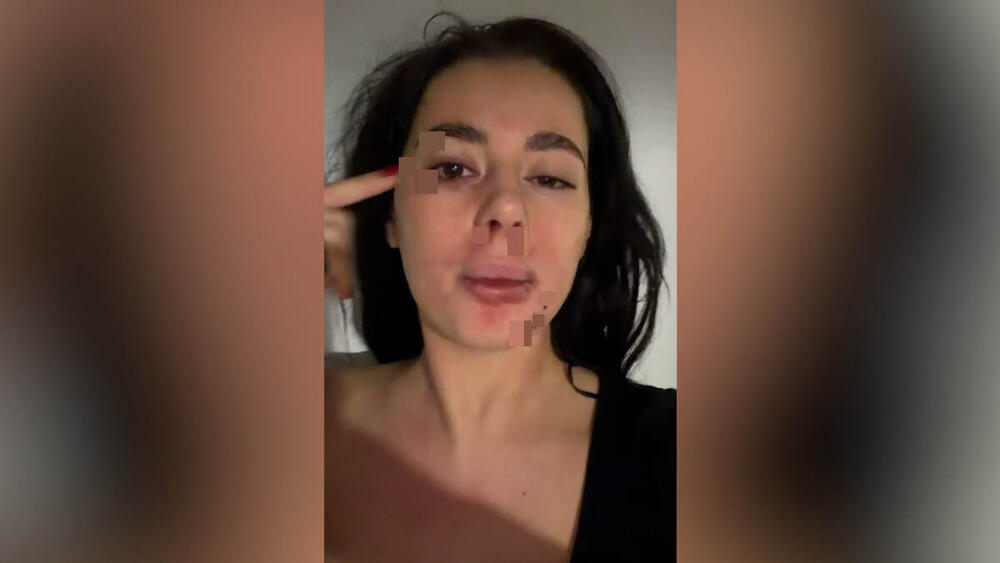 (UZNEMIRUJUĆE SLIKE) PRETUČENA BIVŠA RIJALITI UČESNICA! Naneo joj ozbiljne POVREDE po telu, a evo šta je POVOD