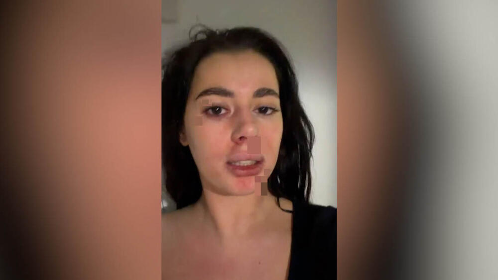 (UZNEMIRUJUĆE SLIKE) PRETUČENA BIVŠA RIJALITI UČESNICA! Naneo joj ozbiljne POVREDE po telu, a evo šta je POVOD